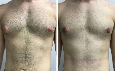 Is It Worth It? A Review of the Best Gynecomastia Surgeon in Dubai