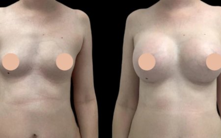 10 Signs You’ve Found the Best Breast Augmentation Surgeon in Dubai