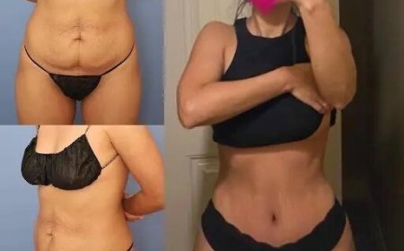 Discover the Secrets Behind the Success of the Best Tummy Tuck Surgeons in dubai
