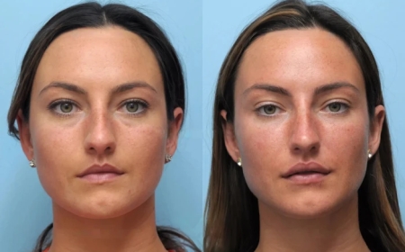 Why Women Are Choosing the Best Plastic Surgeon in Dubai for Thread Lift