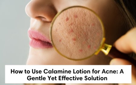 How to Use Calamine Lotion for Acne: A Gentle Yet Effective Solution
