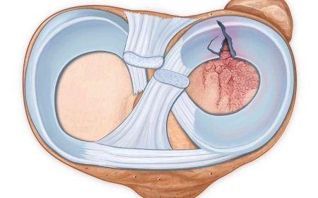 Understanding Meniscal Cysts: From Causes to Surgical Options