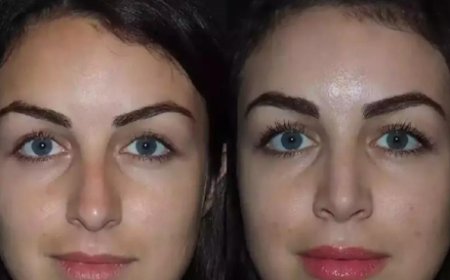 Rhinoplasty in Dubai for a Hooked Nose: Reshaping with Confidence