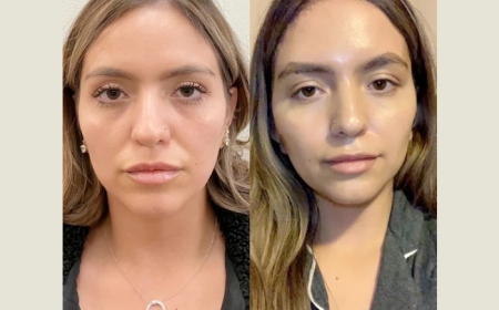 Best Plastic Surgeons in Dubai: Thread Lift for Jawline Contouring and Skin Tightening