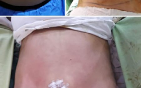 Factors That Affect Liposuction Cost in Pakistan