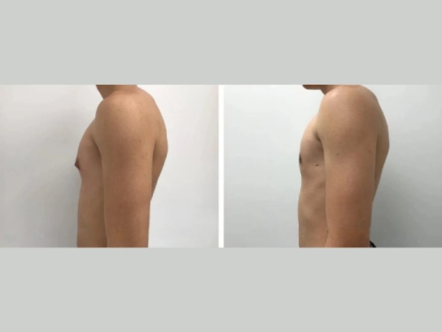 Gynecomastia Before and After: What to Expect from Your Transformation in Dubai