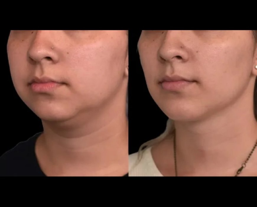 Do Celebrities Choose Double chin removal in Dubai?