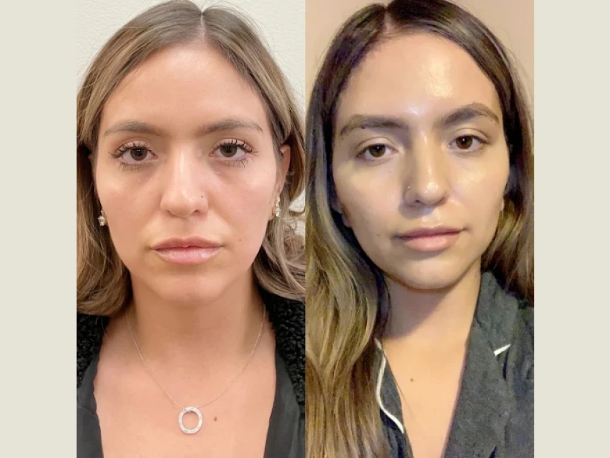 Best Plastic Surgeons in Dubai: Thread Lift for Jawline Contouring and Skin Tightening