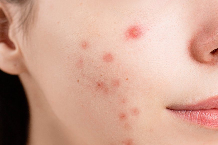 Best Doctor for Acne in Hauz Khas – Clear Skin Begins at Iksana Wellness