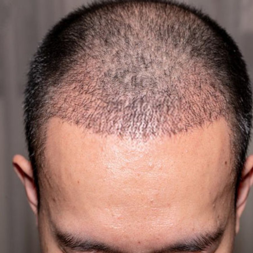 Your Guide to Hair Transplant Bhubaneswar: A Journey to a Fuller Hairline