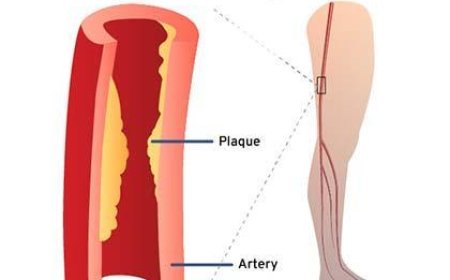 Understanding Peripheral Artery Disease: Causes, Symptoms, and Effective Management