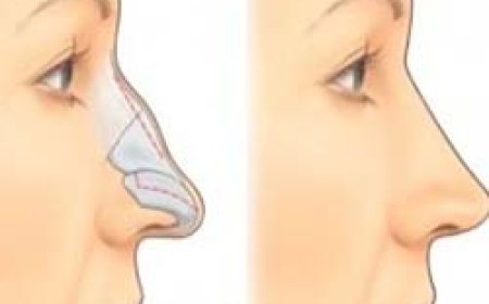 Enhance Your Facial Harmony with Nose Surgery in Islamabad