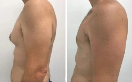What to Expect During Your Recovery from Gynecomastia Surgery in dubai