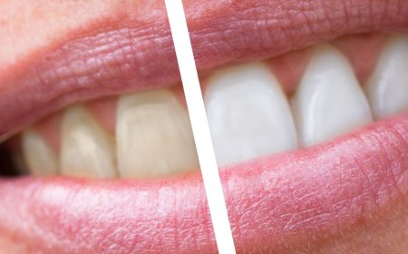 How Often Should You Do Teeth Whitening According to Dentists?