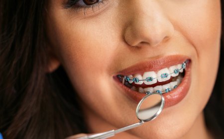 Tips for Managing Discomfort When You Have Braces
