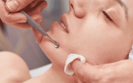 Microneedling Treatment for Face in Chelsea, London — Benefits for Face, Hair, Acne Scars & Stretch Marks
