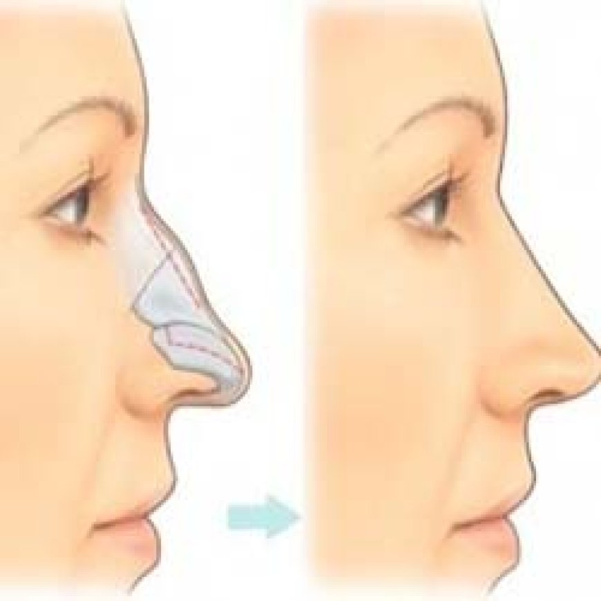 Enhance Your Facial Harmony with Nose Surgery in Islamabad