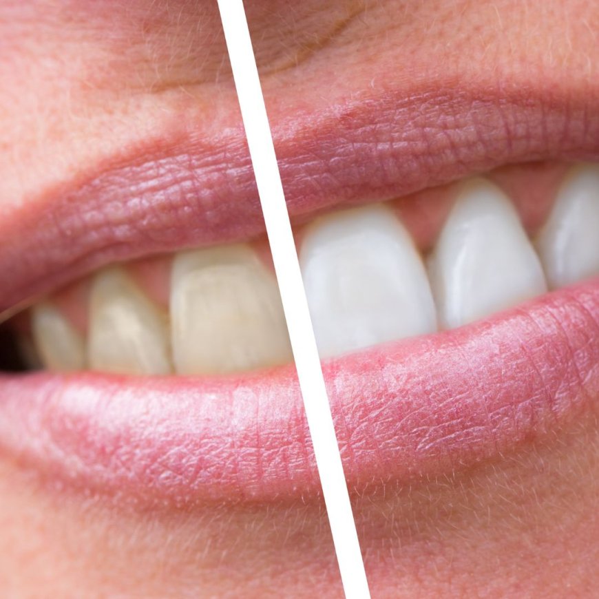 How Often Should You Do Teeth Whitening According to Dentists?