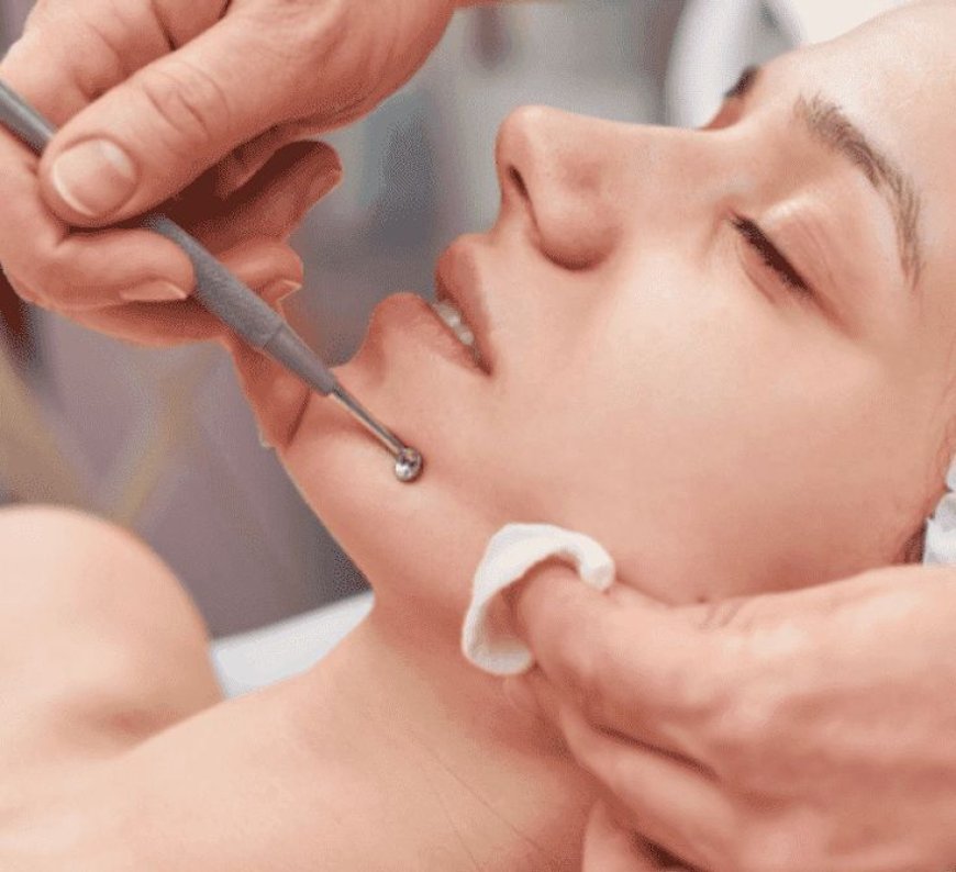 Microneedling Treatment for Face in Chelsea, London — Benefits for Face, Hair, Acne Scars & Stretch Marks